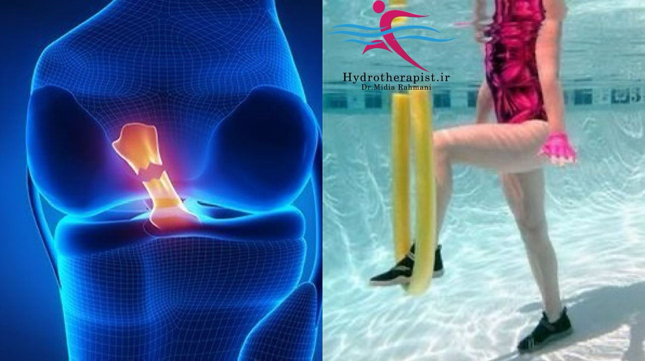 تأثیر آب‌درمانی در بازتوانی آسیب‌های رباط صلیبی (ACL)